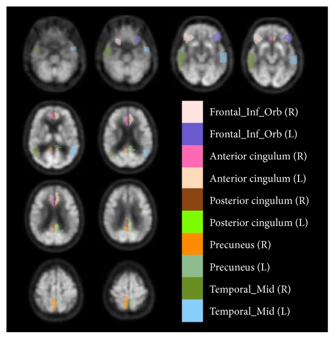 Classification of Alzheimer's and MCI Patients from Semantically Parcelled PET Images: A Comparison between AV45 and FDG-PET.