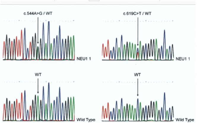 Seizure remission and improvement of neurological function in sialidosis with perampanel therapy