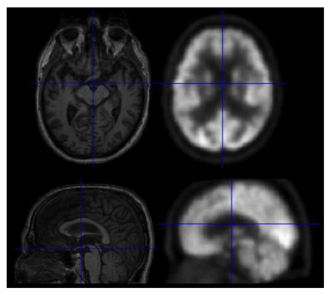 Classification of Alzheimer's and MCI Patients from Semantically Parcelled PET Images: A Comparison between AV45 and FDG-PET.