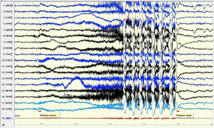 Seizure remission and improvement of neurological function in sialidosis with perampanel therapy