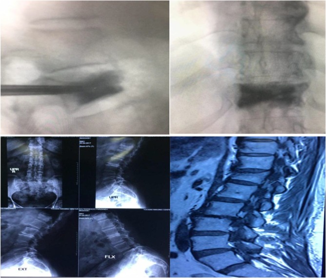 A review and update of vertebral fractures due to metastatic tumors of various sites to the spine: Percutaneous vertebroplasty.