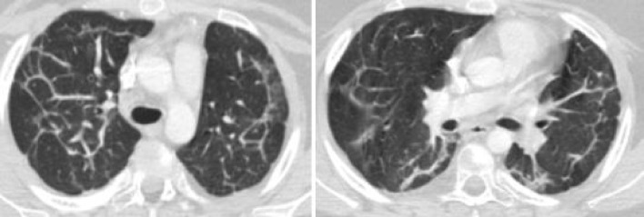 Isolated acute lupus pneumonitis as the initial presentation of systemic lupus erythematosus in an 8-year-old girl.