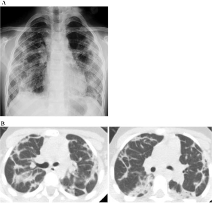 Isolated acute lupus pneumonitis as the initial presentation of systemic lupus erythematosus in an 8-year-old girl.