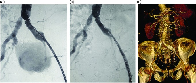 Giant internal iliac artery aneurysm successfully treated with endovascular stent-graft placement.