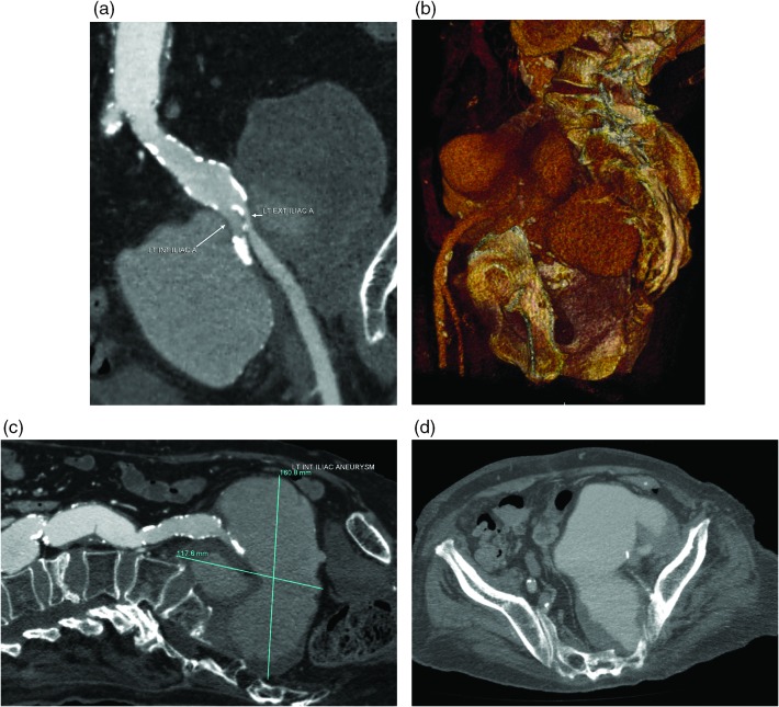 Giant internal iliac artery aneurysm successfully treated with endovascular stent-graft placement.