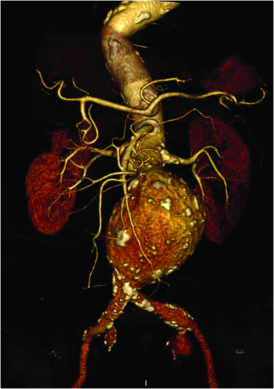 Giant internal iliac artery aneurysm successfully treated with endovascular stent-graft placement.