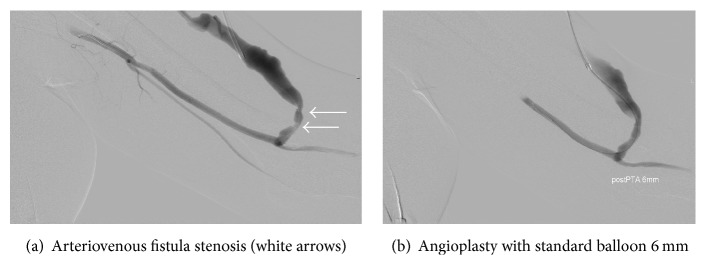 A Review of Percutaneous Transluminal Angioplasty in Hemodialysis Fistula.