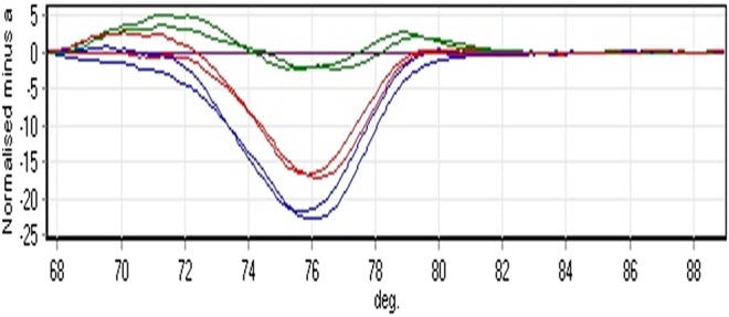 Paraoxonase 1 activities and its gene promoter single nucleotide polymorphisms (-108, -126, and -162) in diabetes mellitus.