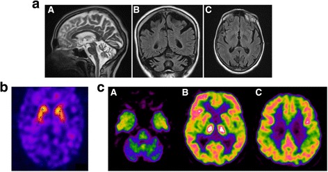 Spinocerebellar ataxia 17: full phenotype in a 41 CAG/CAA repeats carrier.