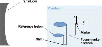 Experimental study of beam distortion due to fiducial markers during salvage HIFU in the prostate.