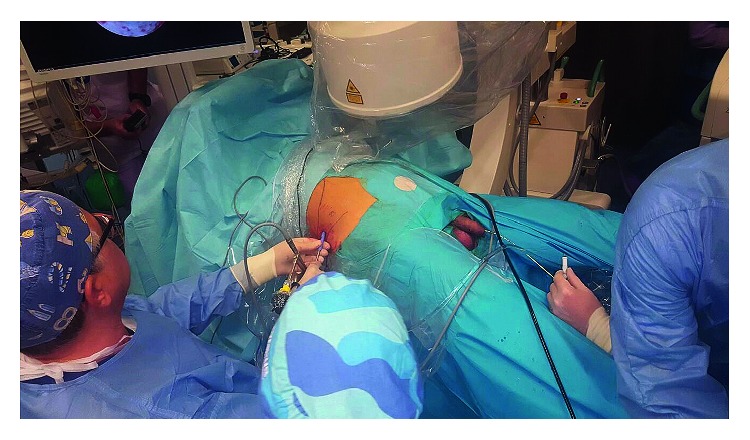 Supine Percutaneous Nephrolithotripsy in Double-S Position.