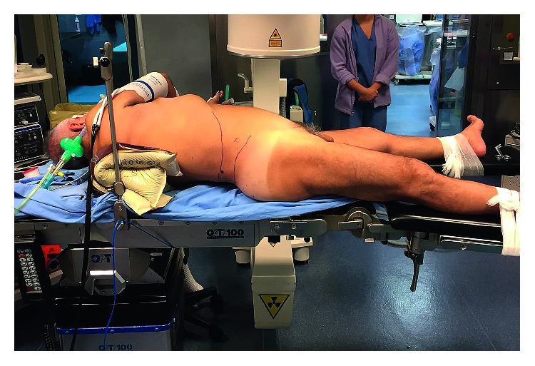 Supine Percutaneous Nephrolithotripsy in Double-S Position.