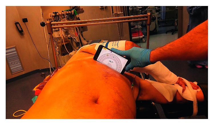 Supine Percutaneous Nephrolithotripsy in Double-S Position.