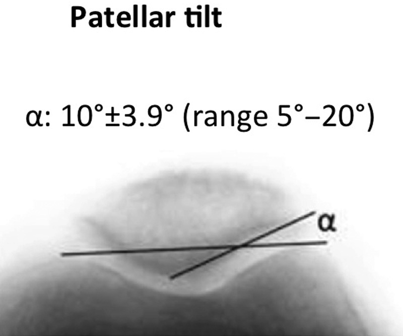 Surgical Treatment of Objective Patellar Instability: Long-Term Results.