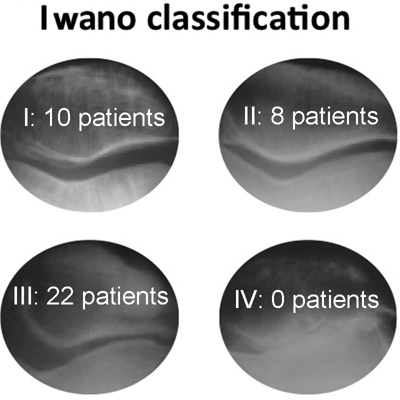 Surgical Treatment of Objective Patellar Instability: Long-Term Results.