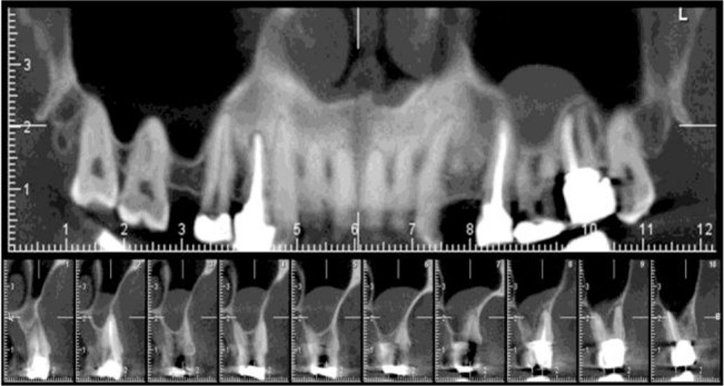 Evaluation of the Prevalence of Mucous Retention Pseudocyst and its Correlation with the Associated Risk Factors Using Panoramic Radiography and Cone-Beam Computed Tomography.