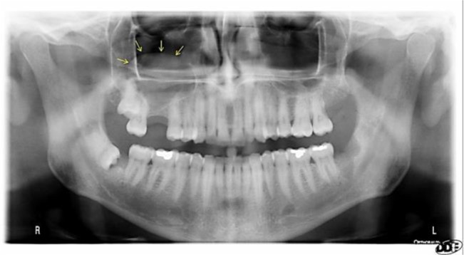 Evaluation of the Prevalence of Mucous Retention Pseudocyst and its Correlation with the Associated Risk Factors Using Panoramic Radiography and Cone-Beam Computed Tomography.