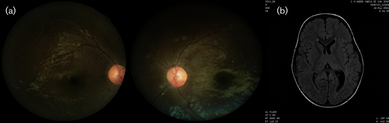 Optic neuropathy and congenital glaucoma associated with probable Zika virus infection in Venezuelan patients.