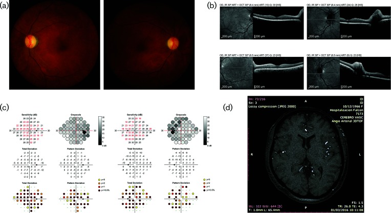 Optic neuropathy and congenital glaucoma associated with probable Zika virus infection in Venezuelan patients.