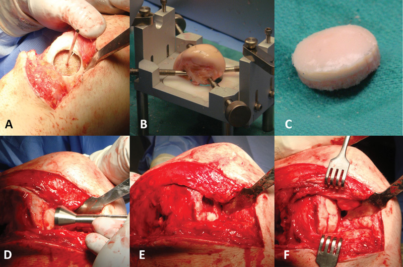 Large Osteochondral Allografts of the Knee: Surgical Technique and Indications.