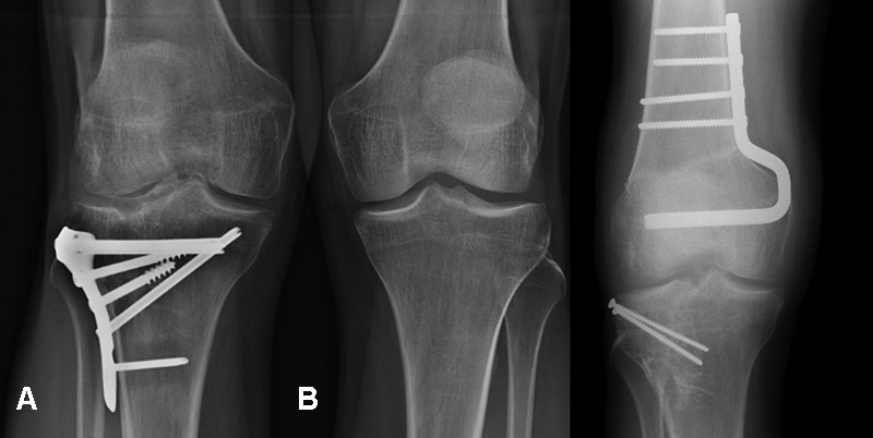 Large Osteochondral Allografts of the Knee: Surgical Technique and Indications.