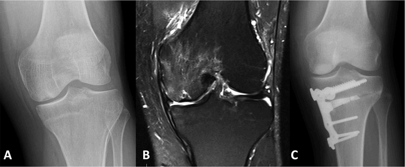 Large Osteochondral Allografts of the Knee: Surgical Technique and Indications.