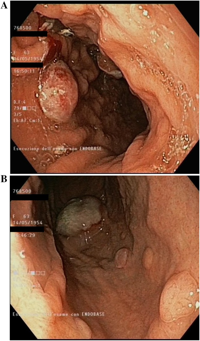 Hyperprogressive Disease and Early Hypereosinophilia After Anti-PD-1 Treatment: A Case Report.