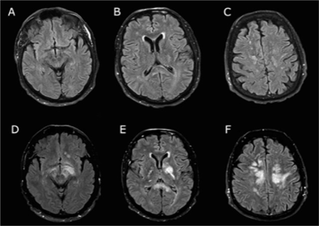 The Diving Bell and the Butterfly Revisited: A Fatal Case of Locked-in Syndrome in a Man With Epstein-Barr Virus-Positive Diffuse Large B-Cell Lymphoma, Not Otherwise Specified.