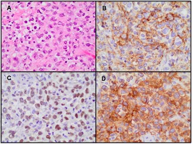 The Diving Bell and the Butterfly Revisited: A Fatal Case of Locked-in Syndrome in a Man With Epstein-Barr Virus-Positive Diffuse Large B-Cell Lymphoma, Not Otherwise Specified.