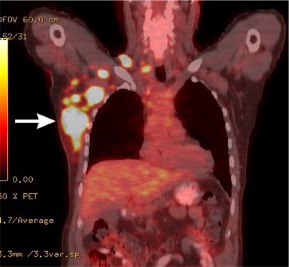 The Diving Bell and the Butterfly Revisited: A Fatal Case of Locked-in Syndrome in a Man With Epstein-Barr Virus-Positive Diffuse Large B-Cell Lymphoma, Not Otherwise Specified.