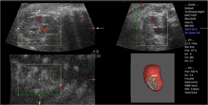 Examination of the vascularization of fetal kidney with three-dimensional power Doppler technique in pregnancies complicated by increased maternal blood pressure.