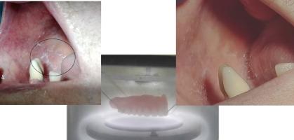 The effect of polymeric denture modified in low-temperature glow discharge on human oral mucosa: Clinical case