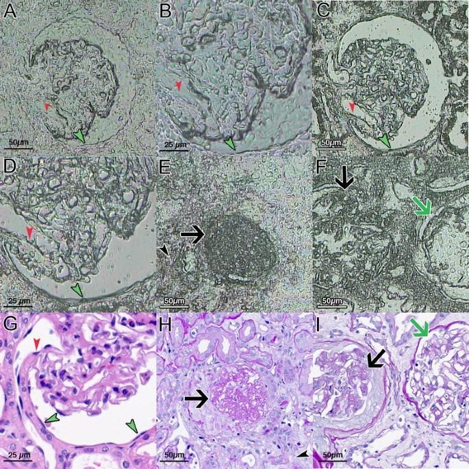 Recommendations for mRNA analysis of micro-dissected glomerular tufts from paraffin-embedded human kidney biopsy samples