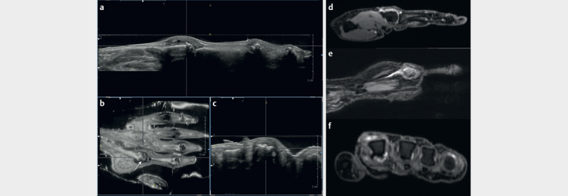 The Value of an Automated Ultrasound System in the Detection of Synovitis.