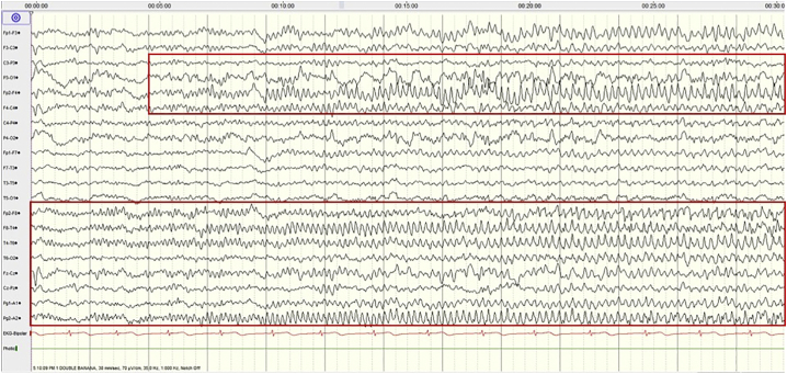 Autoimmune encephalitis associated with two antibodies