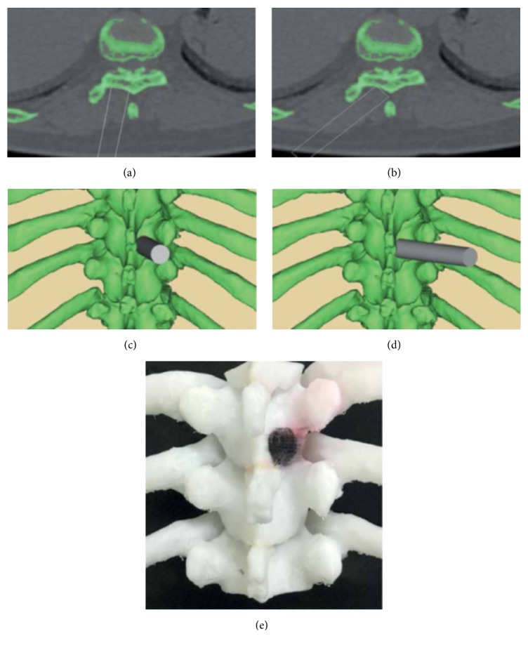 3D Printing Applications in Minimally Invasive Spine Surgery.