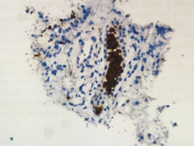 Rhabdomyolysis secondary to systemic lupus erythematosus.