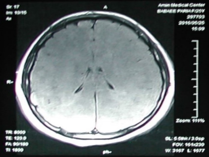 Interferon beta-1b-induced thrombotic thrombocytopenic purpura-hemolytic uremic syndrome (TTP-HUS) in a patient treated for multiple sclerosis: A case report.