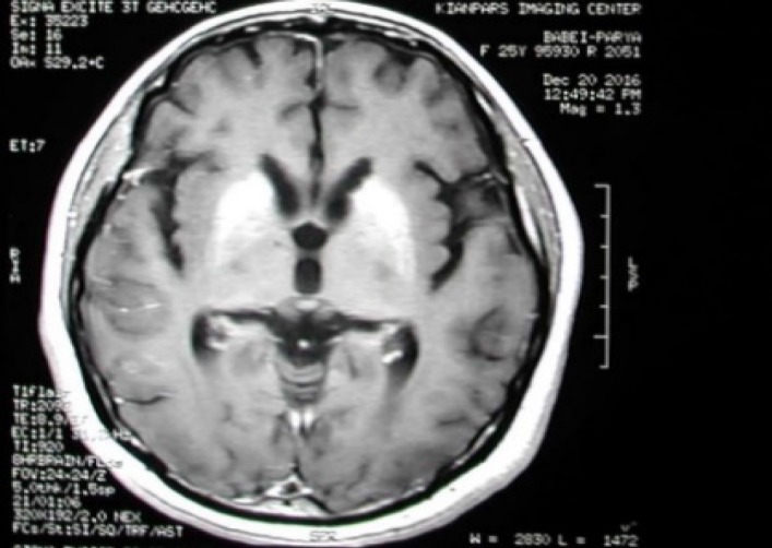 Interferon beta-1b-induced thrombotic thrombocytopenic purpura-hemolytic uremic syndrome (TTP-HUS) in a patient treated for multiple sclerosis: A case report.