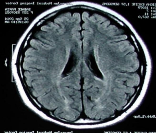 Interferon beta-1b-induced thrombotic thrombocytopenic purpura-hemolytic uremic syndrome (TTP-HUS) in a patient treated for multiple sclerosis: A case report.