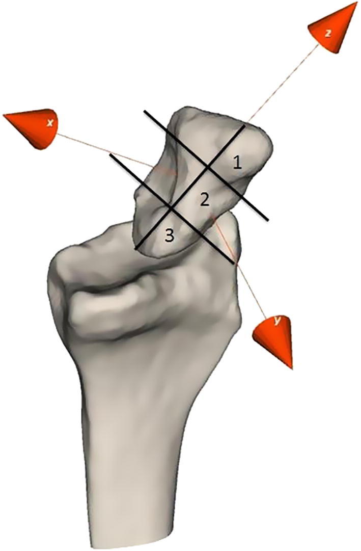 Analysis of instability patterns in acute scaphoid fractures by 4-dimensional computed tomographic imaging – A prospective cohort pilot study protocol