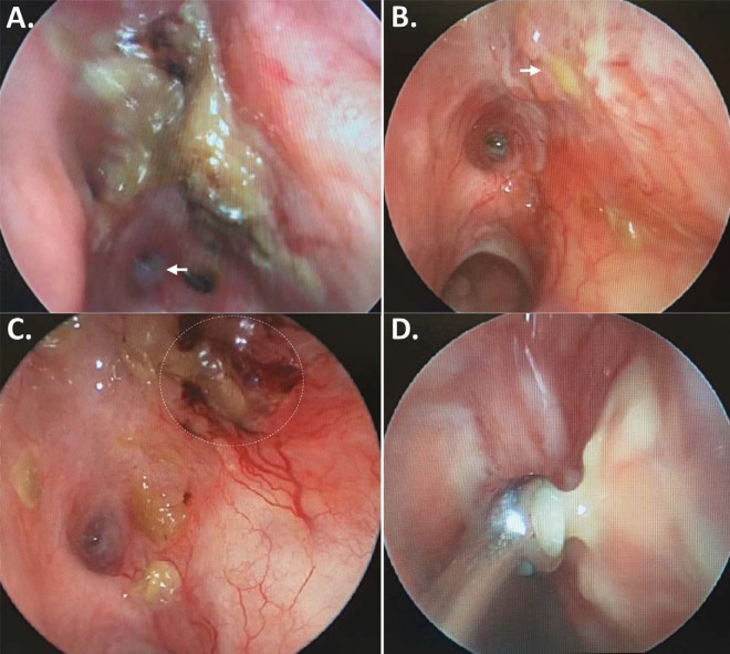 Diagnostic dilemmas of mechanical restriction of the medial rectus: A case report.