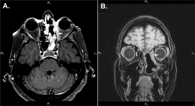 Diagnostic dilemmas of mechanical restriction of the medial rectus: A case report.