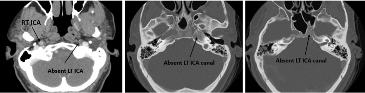 Unilateral internal carotid artery agenesis: Correct diagnosis using computed tomography (CT) scan.