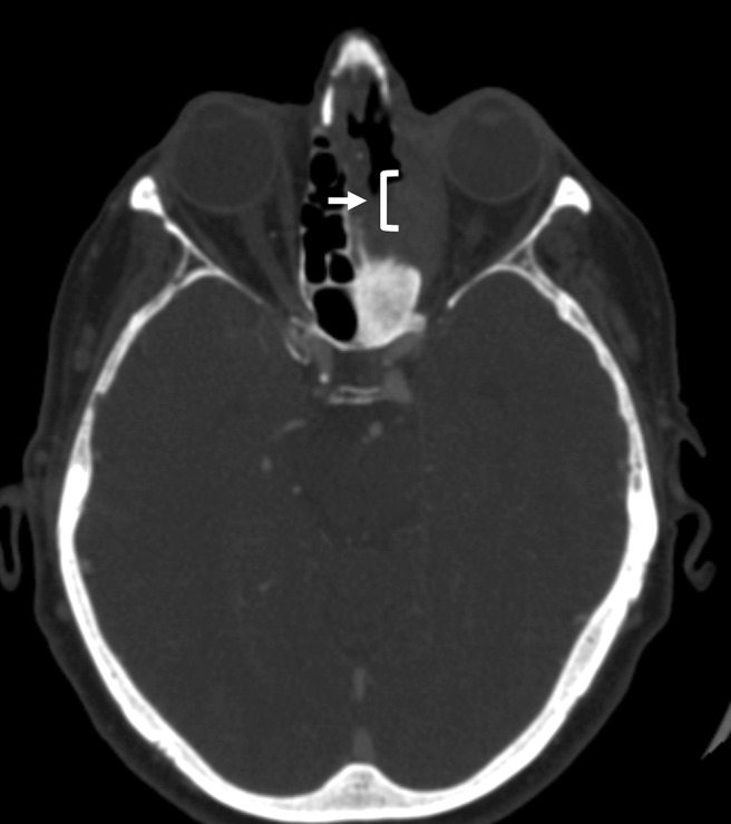 Diagnostic dilemmas of mechanical restriction of the medial rectus: A case report.