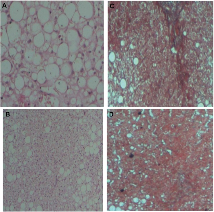 Effect of sitagliptin on hepatic histological activity and fibrosis of nonalcoholic steatohepatitis patients: a 1-year randomized control trial.