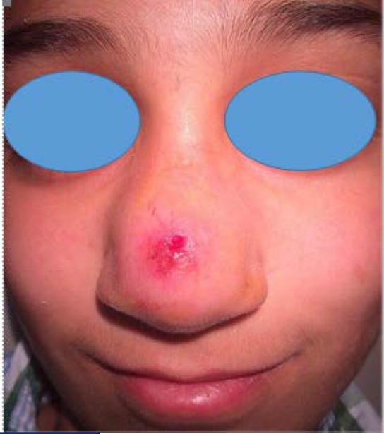 Extranodal Natural Killer/T-cell Lymphoma in a Child with a Prior History of Nasal Trauma: a Case Report.