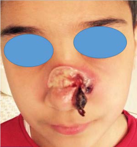 Extranodal Natural Killer/T-cell Lymphoma in a Child with a Prior History of Nasal Trauma: a Case Report.