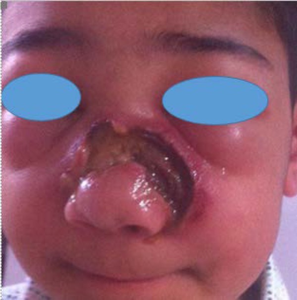 Extranodal Natural Killer/T-cell Lymphoma in a Child with a Prior History of Nasal Trauma: a Case Report.