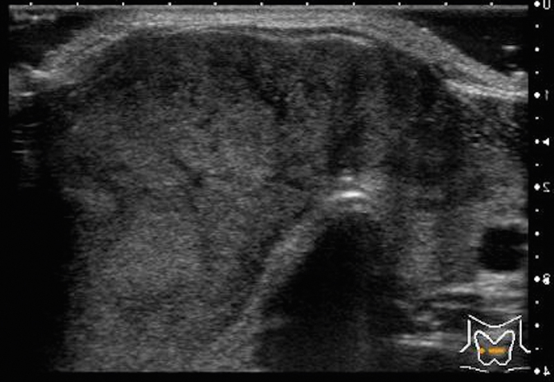 Can Ultrasound Alone Predict Papillary Thyroid Carcinoma with Desmoid-Type Fibromatosis? A Retrospective Analysis of 13 Cases, Focusing on the Stromal Area.